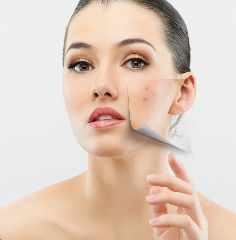 Read more about the article Saiba como se livrar da Acne