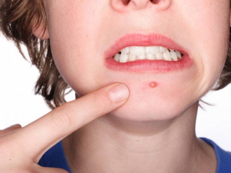 Read more about the article Alimentos que combatem a acne